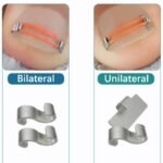 Ingrown Toenail Corrector for Gentle Nail Care