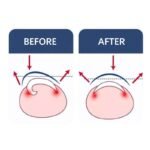 Ingrown Toenail Corrector for Gentle Nail Care
