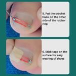 Ingrown Toenail Corrector for Gentle Nail Care